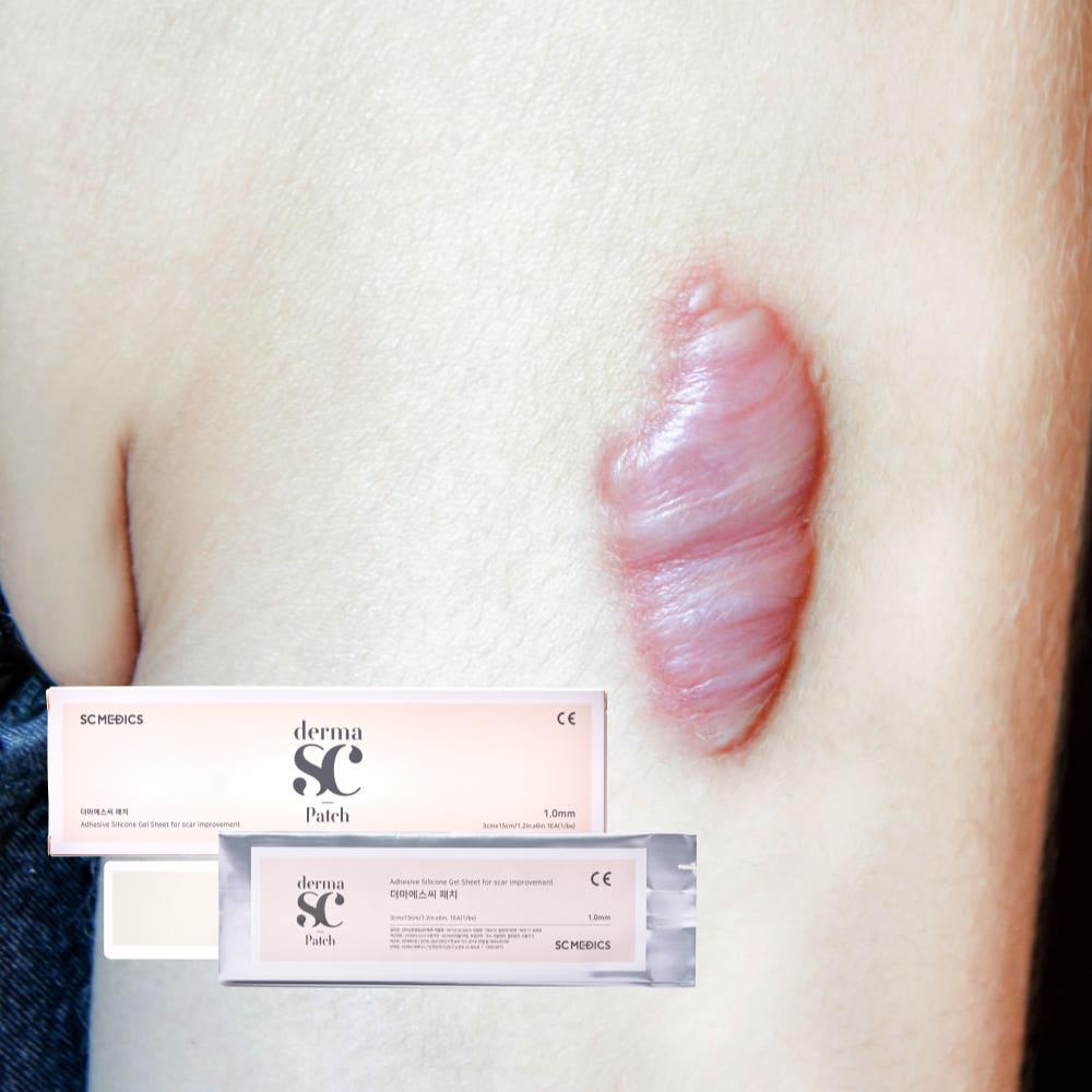 더마에스씨 밴드 흉터 제왕절개 수술 켈로이드 15cm x 3cm 1매입 실리콘 겔 패치