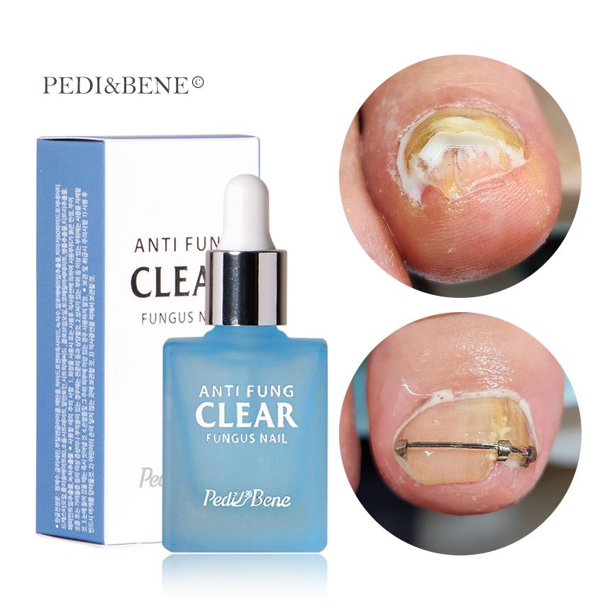 페디베네 안티펑 클리어 10ml 1개